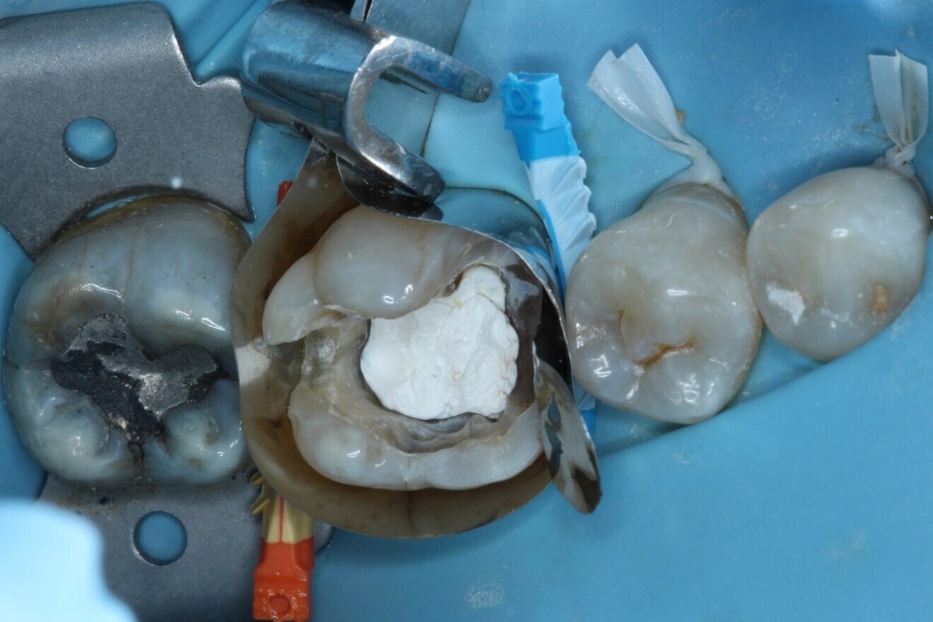 Fig. 6: Band-in-band technique using a sectional matrix within a deep marginal elevation band to restore the marginal ridges.