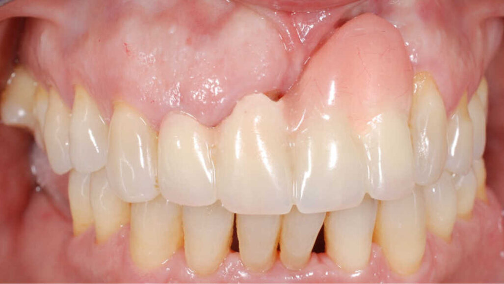 Gestion des tissus mous en cas de mauvais positionnement de l'implant dans la zone esthétique
