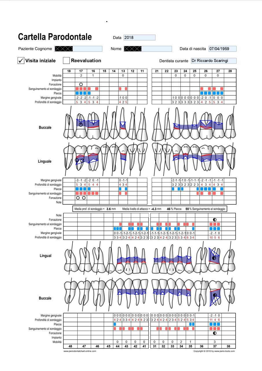 Tab.1_Il casting parodontale è un esame determinante per valutare lo stato di salute di ogni singolo elemento in casi simili è necessario poterlo confrontare nel tempo per valutare i risultati ottenuti e mantenuti.