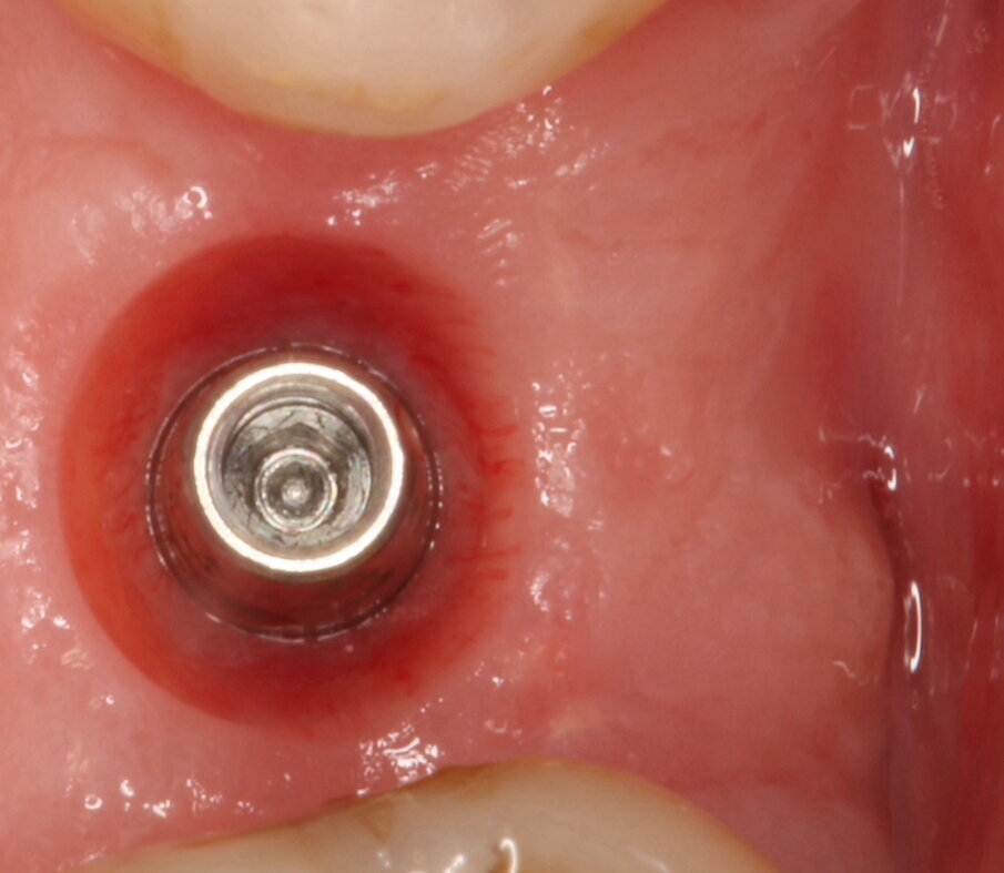Fig. 9_Guarigione dopo 4 mesi con focus sui tessuti molli perimplantari.