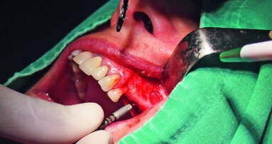 Biomechanical considerations in solving demanding cases