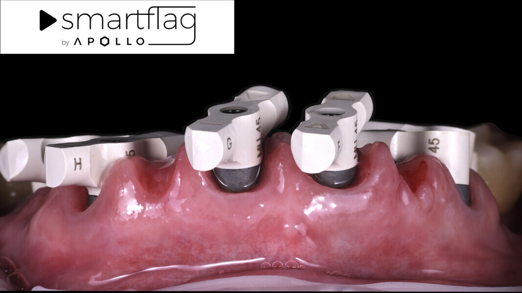 Fig. 29: Intra-oral photograph of the SmartFlag scan bodies in the mouth.