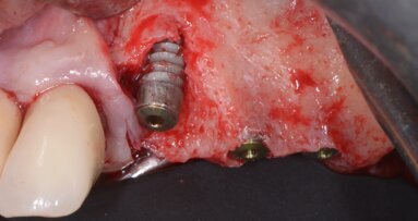 Osseodensificazione, tecnica innovativa per l’elevazione crestale del seno mascellare: Case Report
