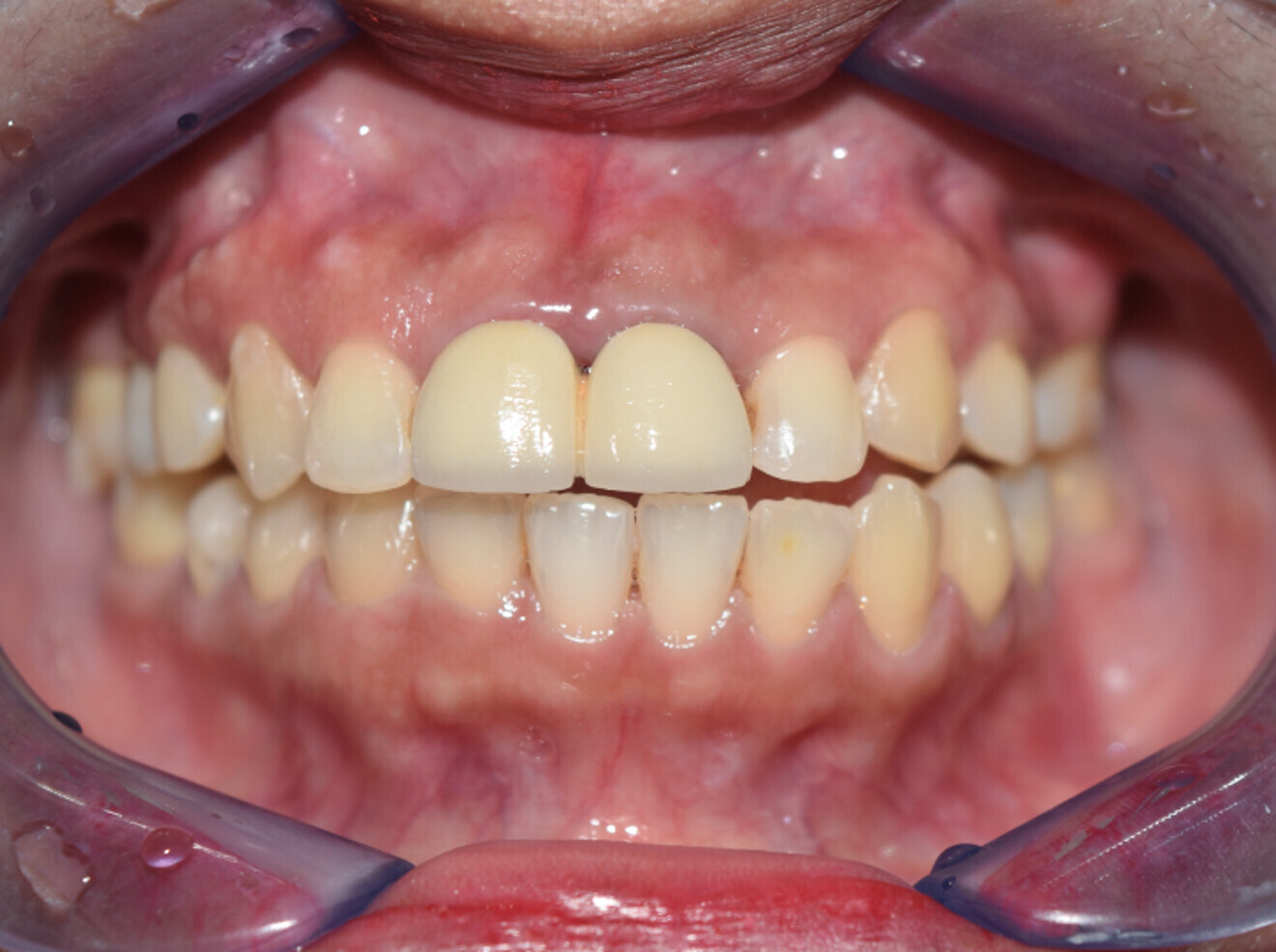 Fig. 13b: 2 years post ortho dontic treatment.
