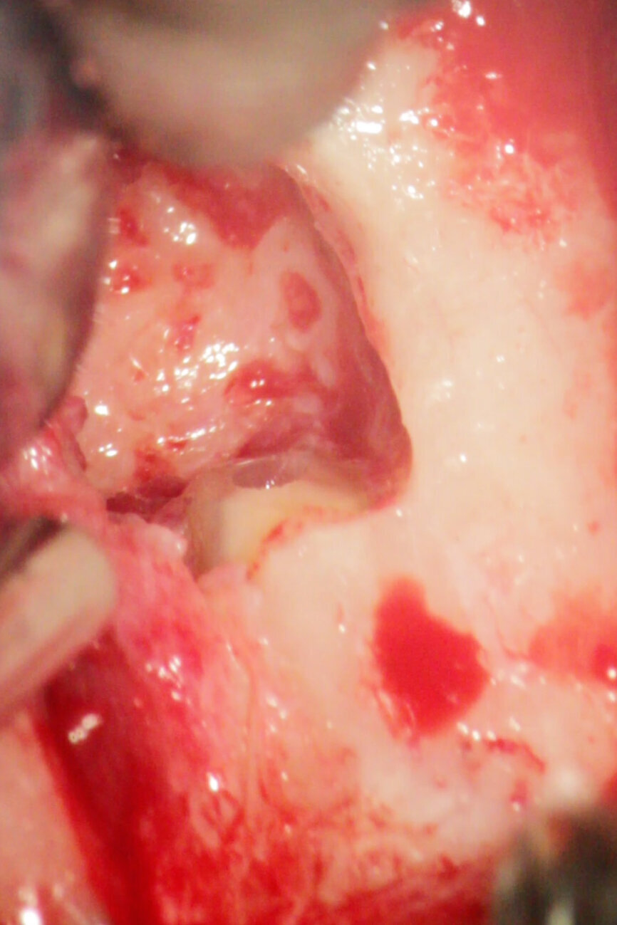 Fig. 4b: (a) Pre-op radiograph with a large periradicular lesion. (b) Periapical surgery. (c) MTA application with the MAP System and PD MTA White. (d) Condensation of the MTA with pluggers. (e) Mirror view of the root-end cavity filled with MTA. (f) Post-op radiograph showing the root-end filling.