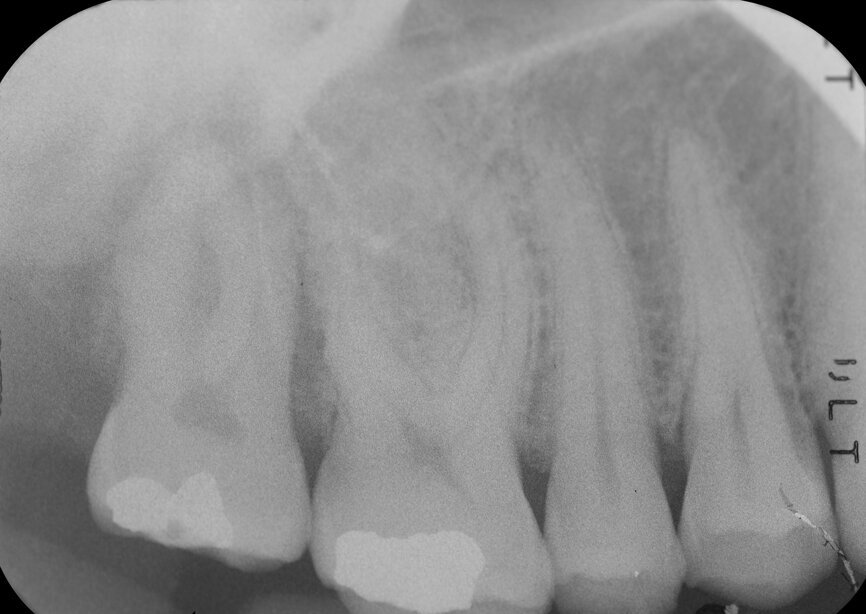 Fig. 9: Post-op periapical radiograph.
