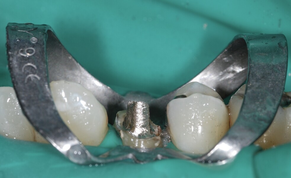 Fig. 7 : Tenon avec dimensions réduites préparé pour le retrait à l’aide d’un extracteur.