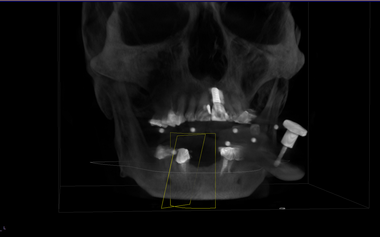 Fig. 6: The Yomi link with ducial arrays attached in a CBCT scan.