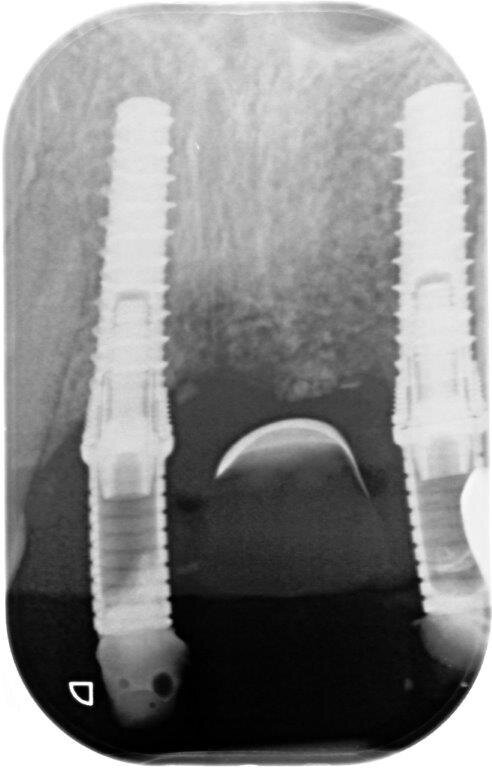 Fig. 22a, 22b - Valutazione dei tessuti duri e molli perimplantari.