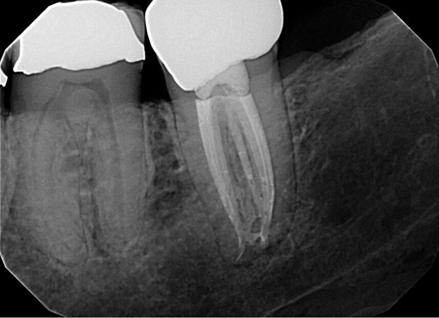 Fig. 19: Note the degree of penetration of sealer and gutta-percha between the primary canals. Obturation of this space demonstrates both the ‘macro’ and ‘micro’ cleaning referred to in the article. (Courtesy of Dr. Nestor Cohenca)