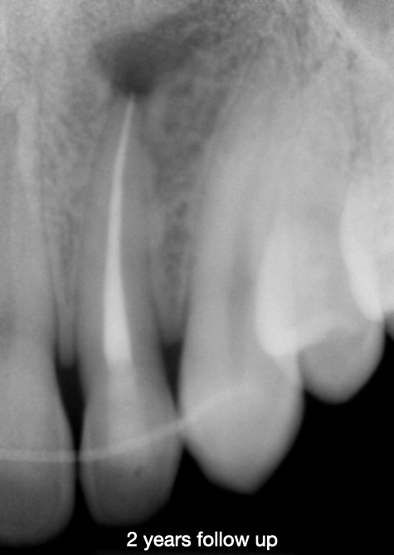 Fig. 5c: Radiograph at two years, showing an area of less bone condensation at the root.