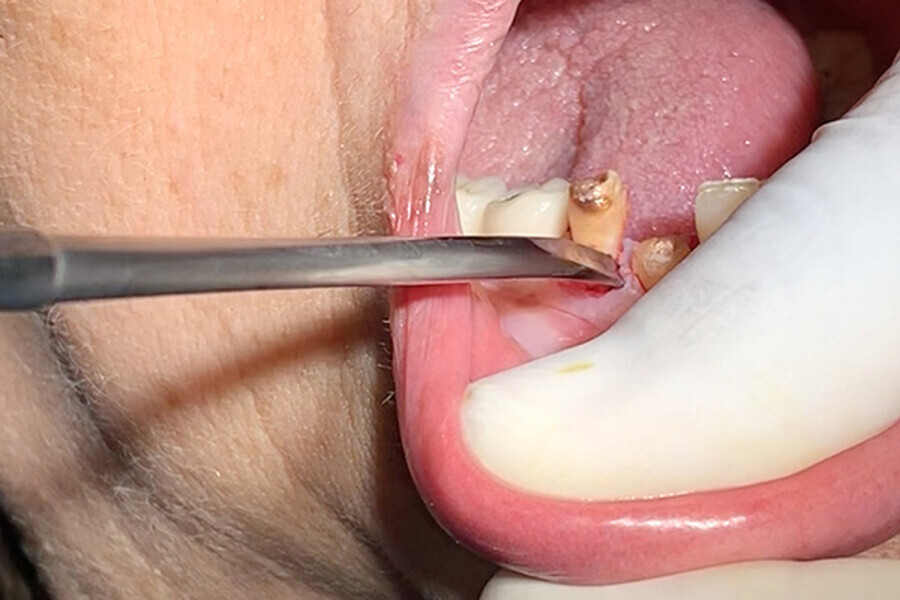 Figs. 6. Uso de Botador fino para complementar la luxación.