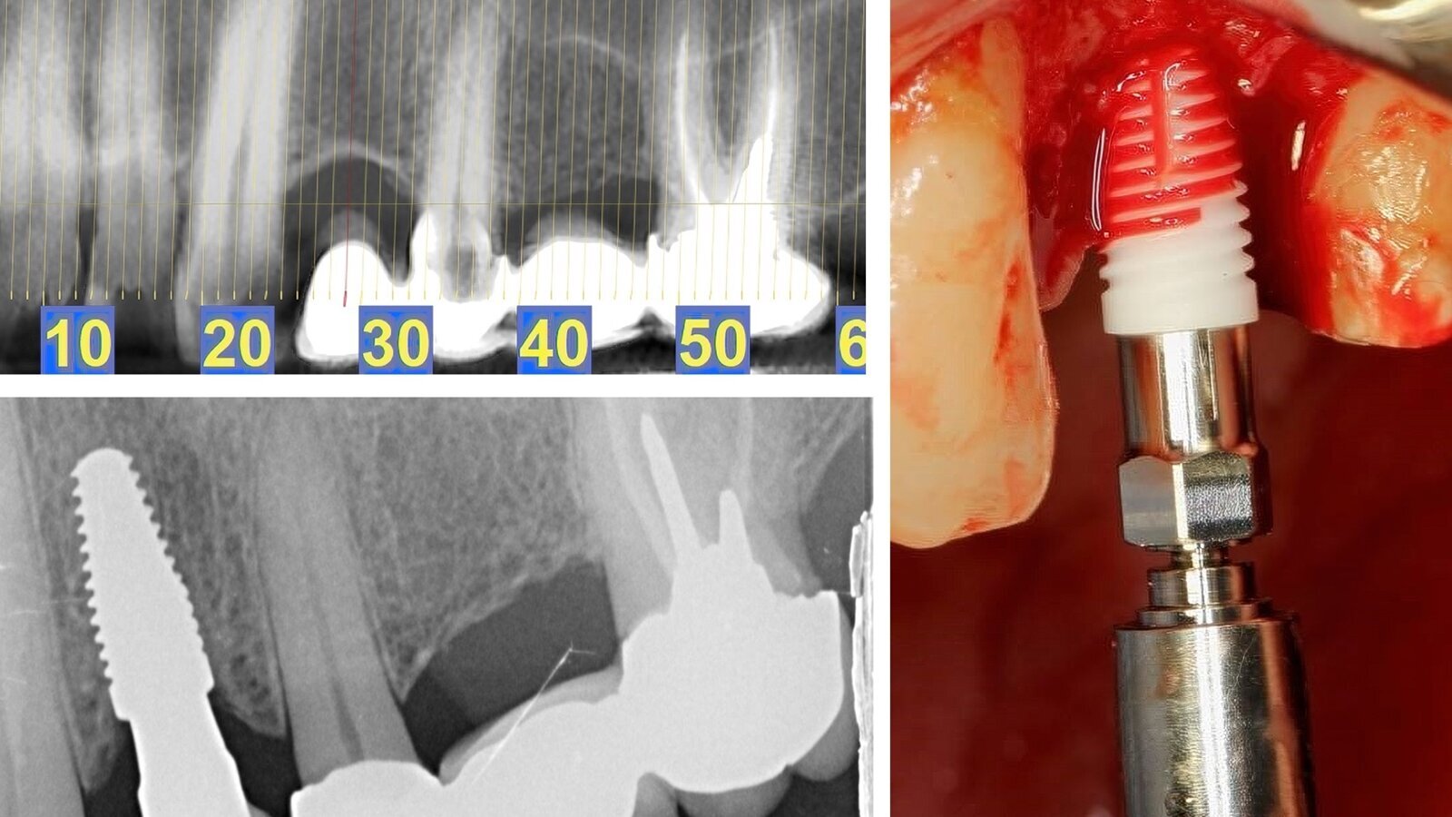 Rehabilitación estética en la región posterior con implantes cerámicos