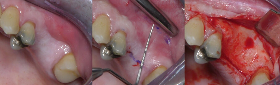 Fig. 4 - Aspetto clinico del mascellare posteriore sinistro e disegno del lembo. Viene eseguita una sola incisione sul versante occlusale e mediale della cresta, preservando la papilla dell’elemento residuo più distale. Non si eseguono incisioni di scarico; viene sollevato un lembo a tutto spessore.