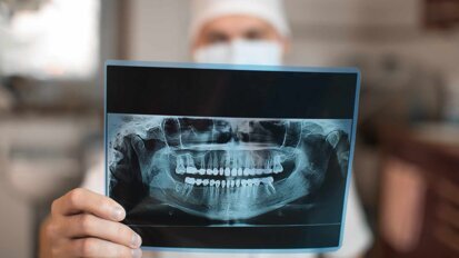 Beseitigung von Karies und Parodontitis erhöht Sicherheit bei Endoprothesen Beseitigung von Karies und Parodontitis erhöht Sicherheit bei Endoprothesen