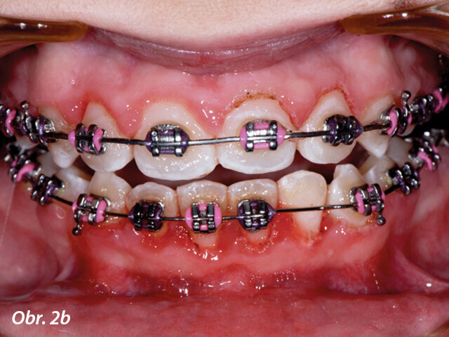 Okamžitě po ošetření.