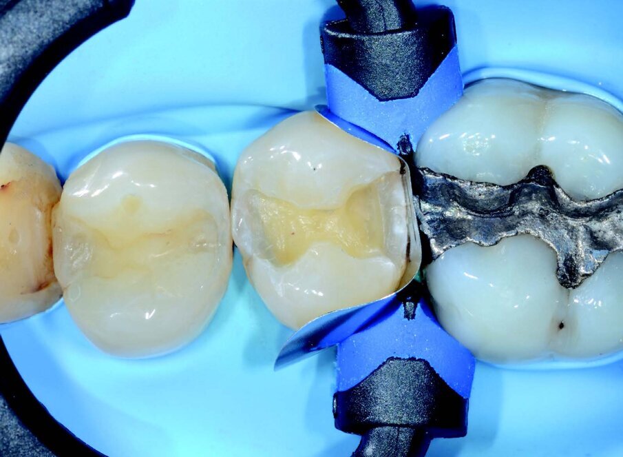 After finishing of the cavity, a sectional matrix Composi-Tight 4.6 mm, a wooden wedge and 3D XR ring are placed. The ring is placed on the wedge and causes a slight divergence which will result in an excellent point of contact at the end of the restoration.