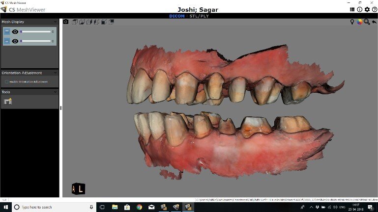 Fig 12: Same patient with digital impressions done for all the tooth preps in the process of a full mouth rehabilitation