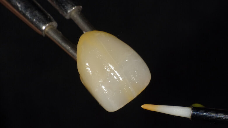 Caracterización de una restauración de cerámica híbrida