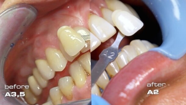 Wybielanie zębów z nadwrażliwością zębiny laserem diodowym