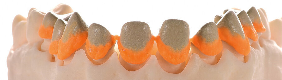 Fig. 6 & 7: Application of the ceramic margin using the Margin materials of the two ceramic systems (left: IPS d.SIGN; right: IPS Style)