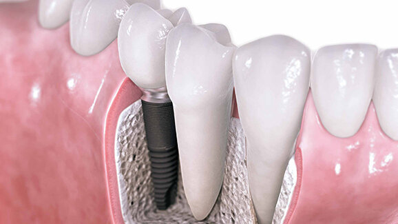 Десет факта за денталните импланти