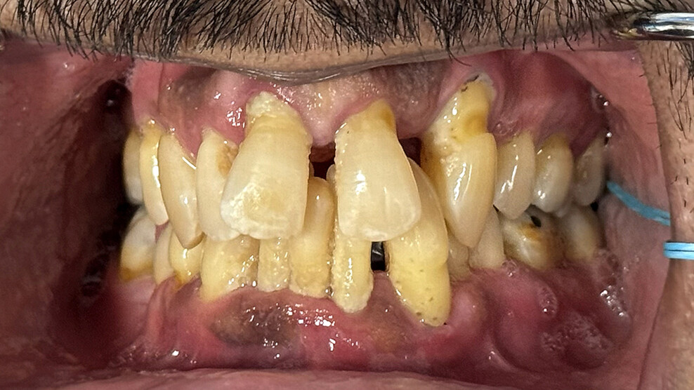 Fig. 1b: Pre-op situation. Intra-oral retracted view of the maxillary and mandibular teeth in occlusion.