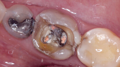 Endocrowns milled from CAD/CAM composites for high strength and flexibility