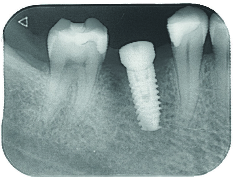 Fig. 15 : Contrôle radiologique de la bonne adaptation de la vis de cicatrisation.