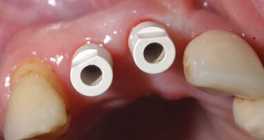 Chirurgie guidée et mise en charge immédiate. Résultats cliniques et radiologiques