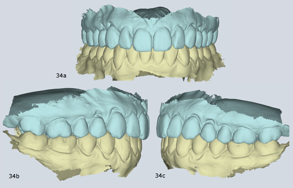 Figs. 34a–c: Virtual articulator mounting with MODJAW demonstrating orthopaedic stability.