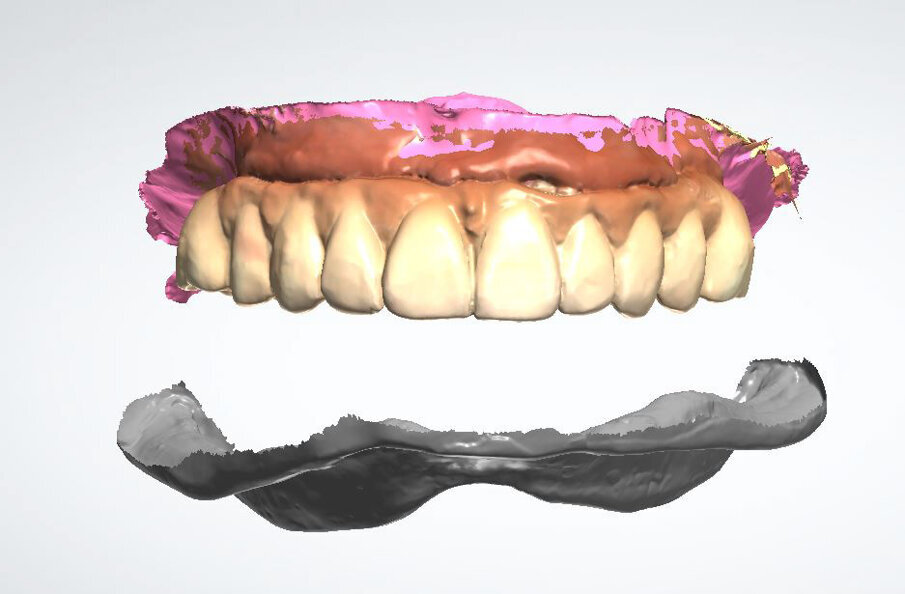 Fig. 4_Scansione intraorale superiore e inferiore.