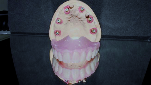 An implant-supported prosthetic restoration concept for edentulous atrophied maxillae