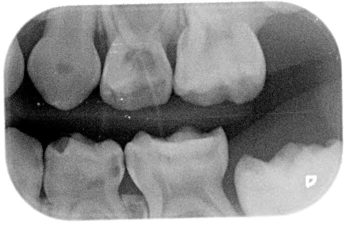 Afbeelding 4b. Bitewings na 3 jaar. Laesie 74 distaal wordt beslepen.
