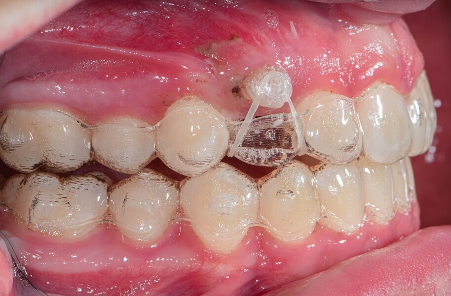 Fig. 4: Progress photographs showing a clear Precision Aligner Button which the surgeon attached to the canine. Notches were placed for the bootstrap elastic on the lingual aspect of the maxillary lateral incisor and first premolar, using the Tear Drop instrument.
