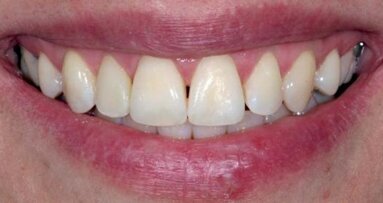 Zmiana kształtu siekacza bocznego za pomocą licówki kompozytowej wykonanej metodą bezpośrednią