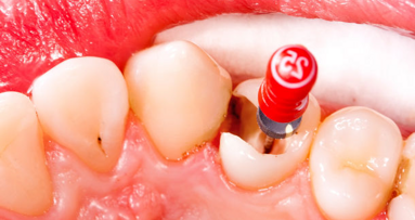 Дентални пациенти получават 35 млн. долара компенсация