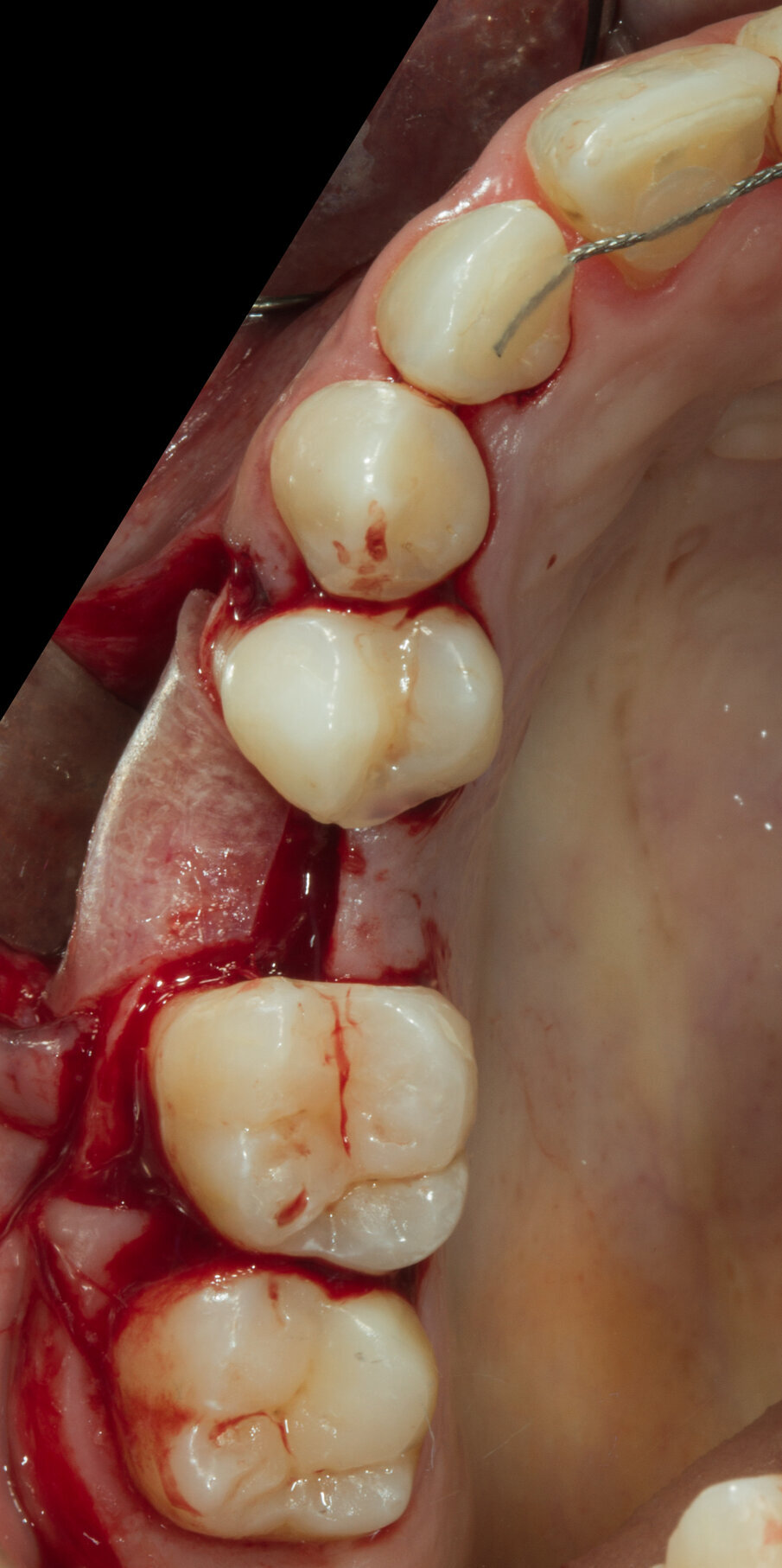 Fig. 11 - La Lamina Corticale viene ripiegata su osso stabile crestale.
