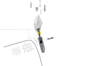 Dentsply Sirona – XiVE