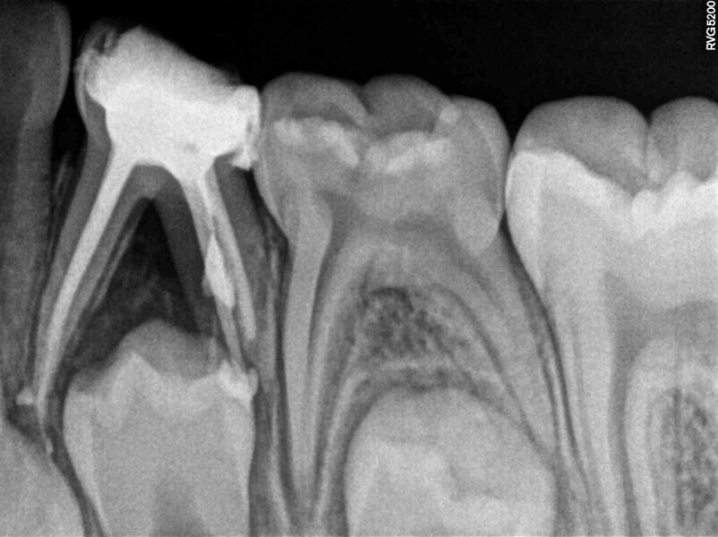 Fig. 7 : Obturation et restauration provisoire.