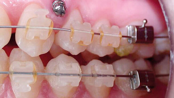 Parodontologisch-kieferorthopädische Behandlung Erwachsener