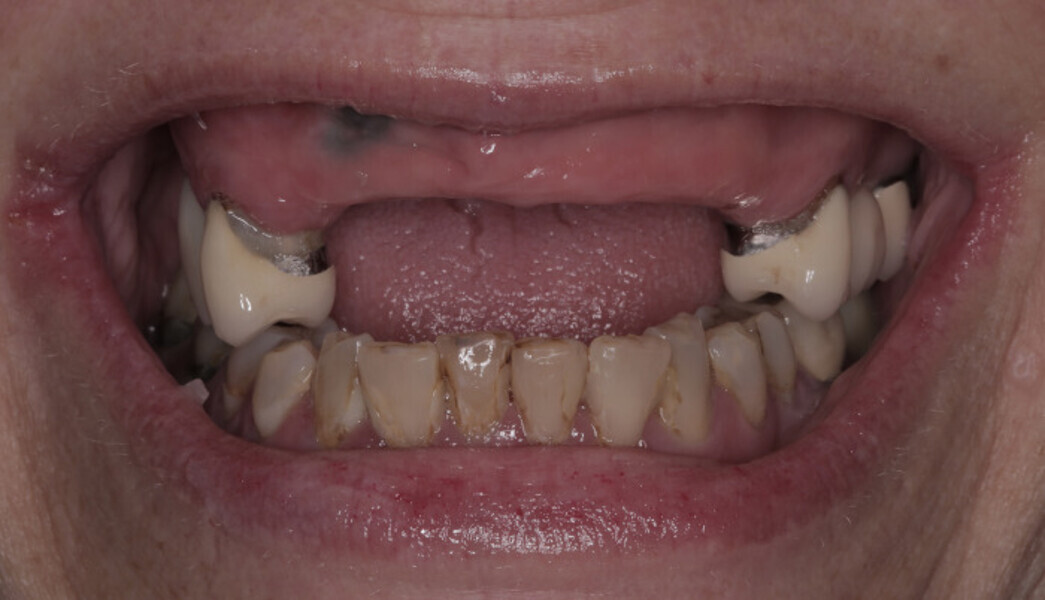 Fig. 6a: High smile line without (a) and with the intra-oral mock-up (b).