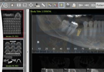 AB implants global success spreads rapidly into Canada AB implants global success spreads rapidly into Canada