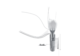 Dentsply Sirona – ANKYLOS