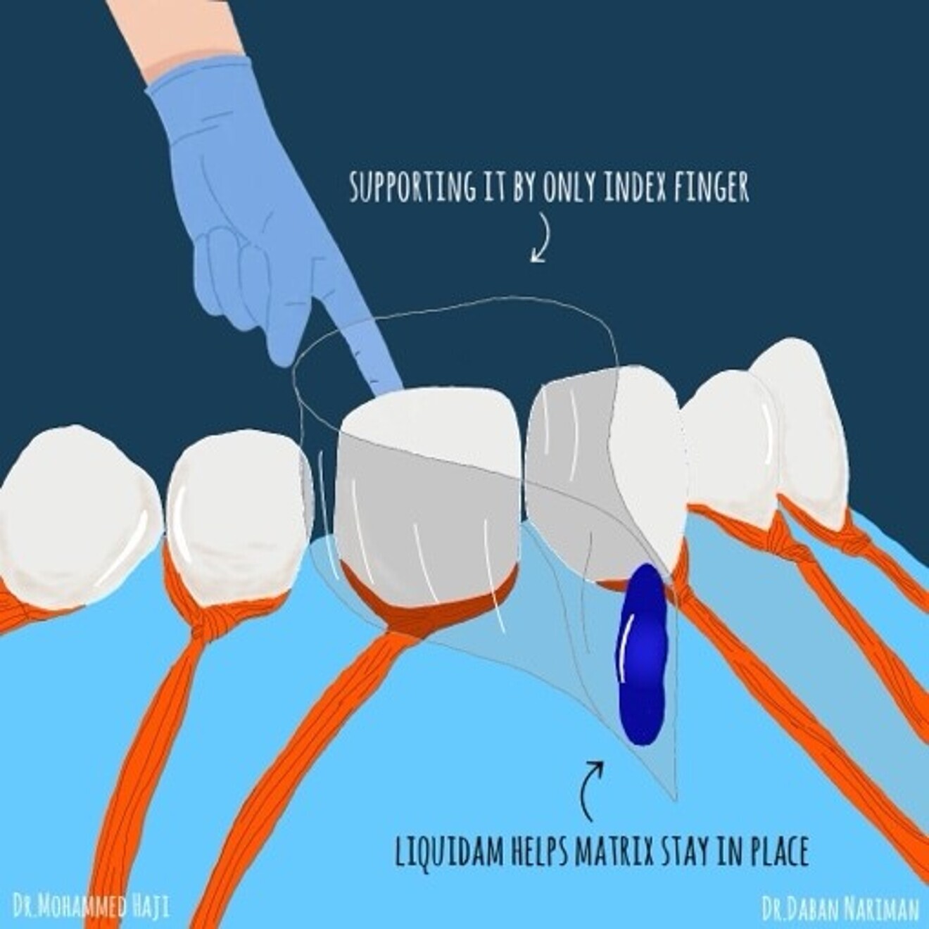 Fig. 1b: Place the clear  matrix in the mouth and support with the index finger.