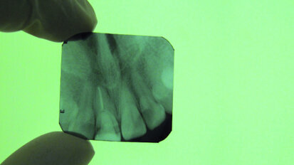 Ostéo-intégration assistée par laser : une diode laser pour la pose d’un implant de type I