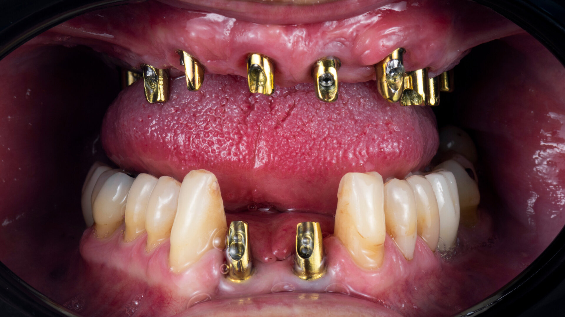 Impact of China’s volume-based procurement on the Asia Pacific dental implant market