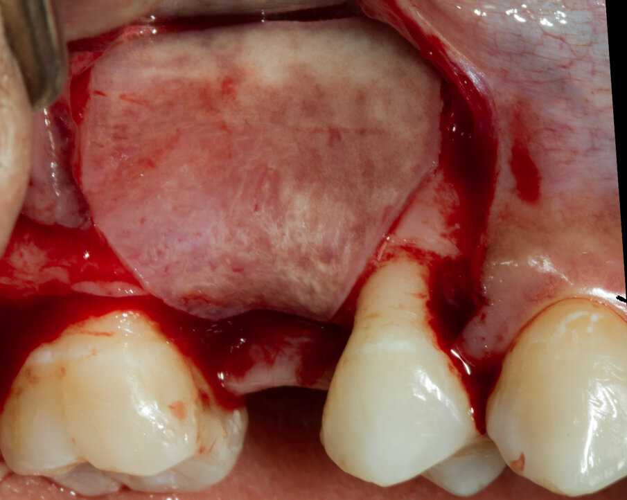 Fig. 10 - Lamina Corticale stabilizzata con Tisseel sul tavolato osseo vestibolare.