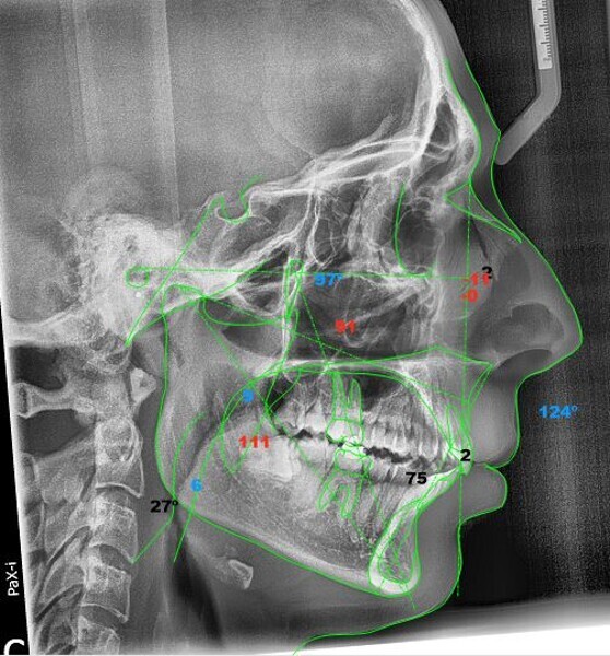 Fig. 21: McNamara cephalometric analysis after the orthodontic treatment (image generated by NemoCeph Studio).