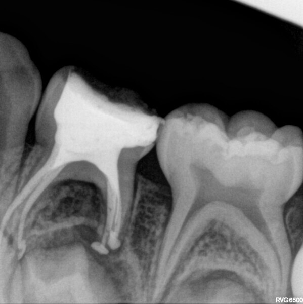 Fig. 16 : Obturation de quatre canaux radiculaires.